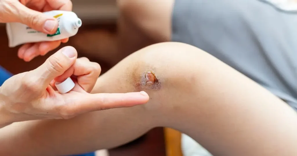 Bacitracin Topical Antibiotic